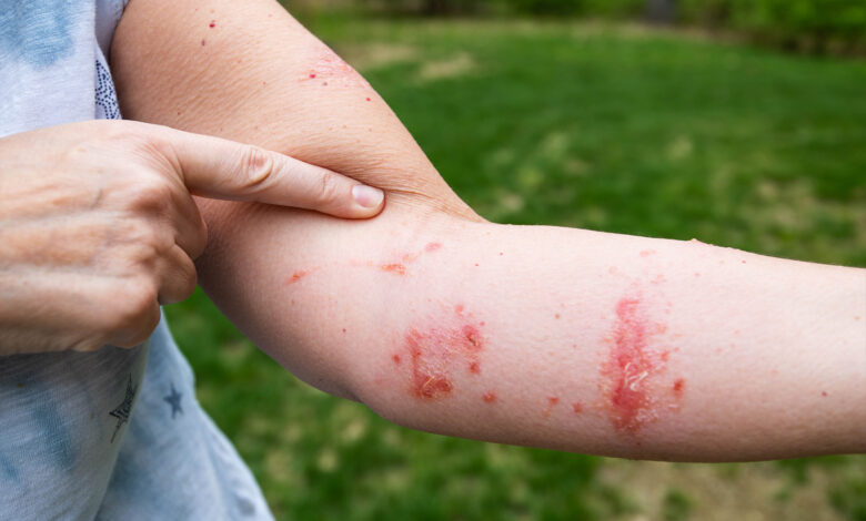POISON IVY: A Miserable Rash! – Dr. G Opines